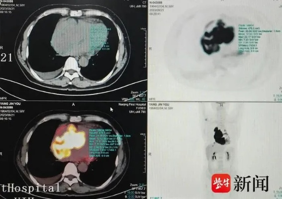 男子胸部脓液X光现刀留体内8年，奇迹避心脏血管惊现新疗法