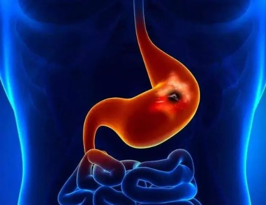 27岁女子胃萎缩暴瘦35斤离世,揭示健康危机新警示 27岁女子胃萎缩暴瘦35斤离世,揭示健康危机新警示