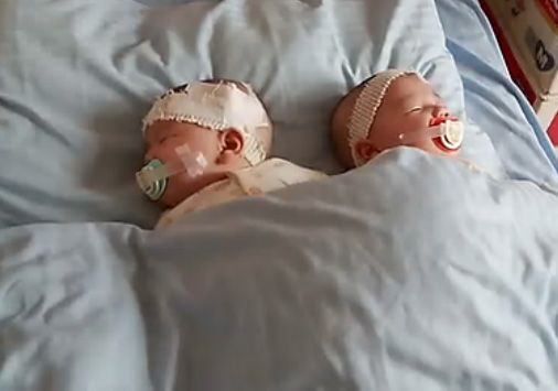 连体双胞胎分离奇迹变悲剧，生命奇迹见证新挑战