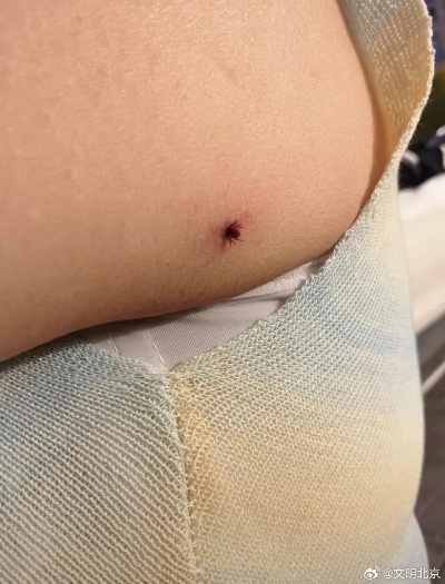 户外被蜱虫叮咬飞行员14天后烧烤汉堡致命之谜