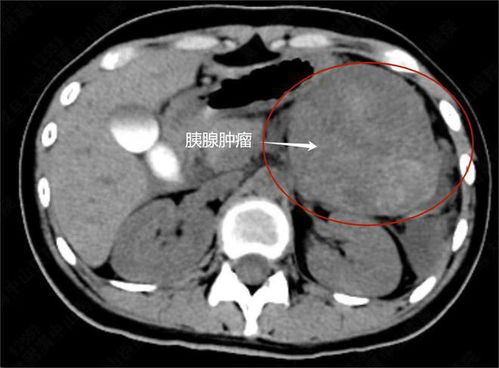 13岁女孩腹腔肿瘤惊人,长期二手烟暴露成主因,健康警示需重视 13岁女孩腹腔肿瘤惊人,长期二手烟暴露成主因,健康警示需重视