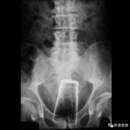 男子直肠惊塞一战炮弹，防爆精英紧急救援！