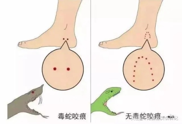 女童遭蛇咬后咬死蛇，蛇种鉴定+儿童蛇咬黄金10分钟急救全攻略