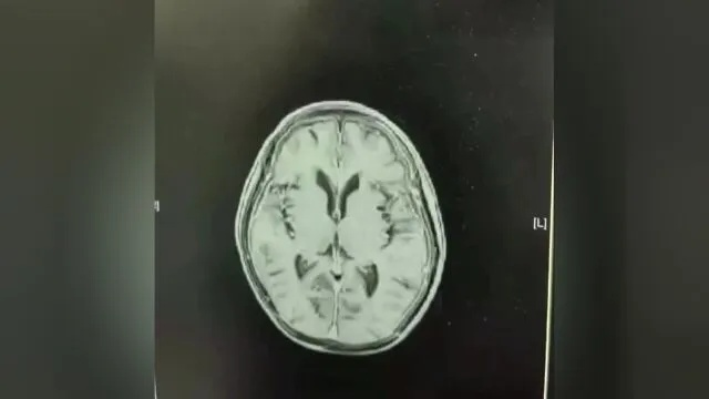 5米高坠男子感染超级细菌,高烧不止,脑脊液如果冻般浑浊 5米高坠男子感染超级细菌,高烧不止,脑脊液如果冻般浑浊