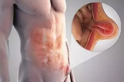 医生发出警告，模仿 Ella真空腹，小心疝气找上门！