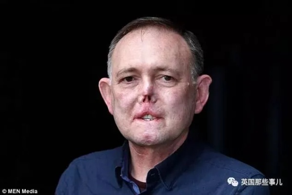 奥斯卡舞台现残障毁容演员，面部良性肿瘤挡不住他闪耀光芒