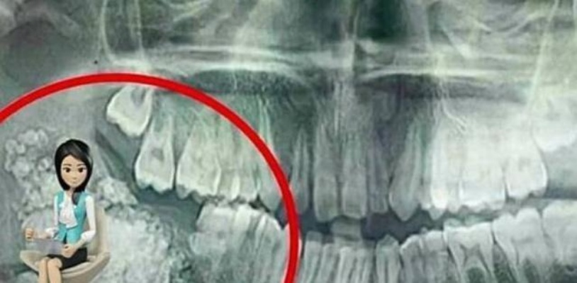 18岁少女跳操后腹痛不止，肿块里竟藏24颗牙齿