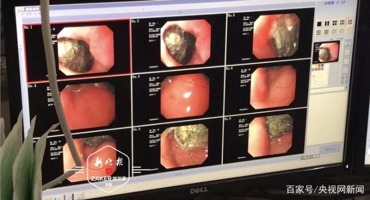 18岁少女跳操后腹痛不止发现肿块 里面竟含24颗牙齿