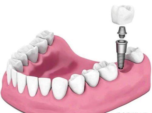 日本牙科麻醉剂断供 无麻药硬拔牙齿引担忧