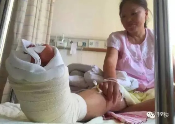 惊！50岁女子睡梦中竟遭粉碎性骨折，连医生都直呼不可思议