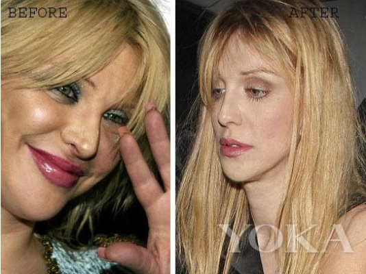 后悔整容!女星布鲁克斯・纳德如今皮肤坑坑洼洼,直言悔不当初 后悔整容!女星布鲁克斯・纳德如今皮肤坑坑洼洼,直言悔不当初