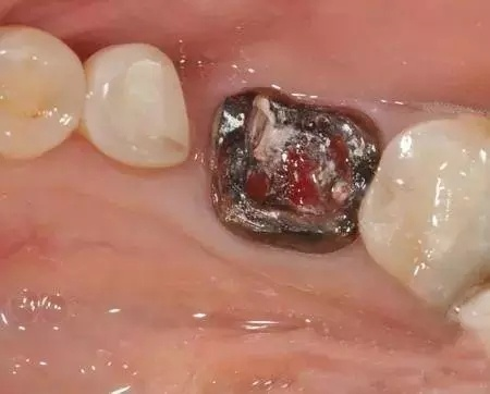 车祸撞坏5颗牙索赔40年换牙费，法院最终判决结果揭晓！