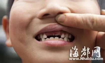 车祸被撞坏5颗牙 一次性索赔40年换牙费！法院判了